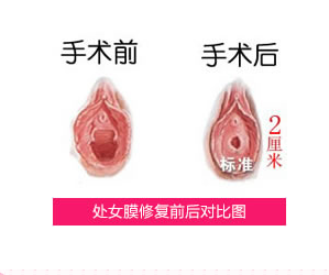 处女膜修复术