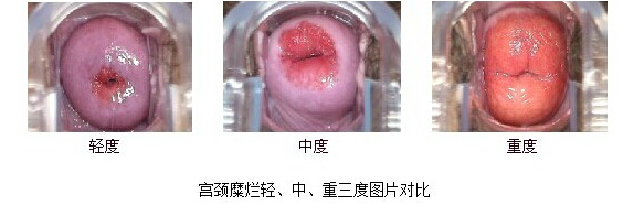 济宁宫颈糜烂